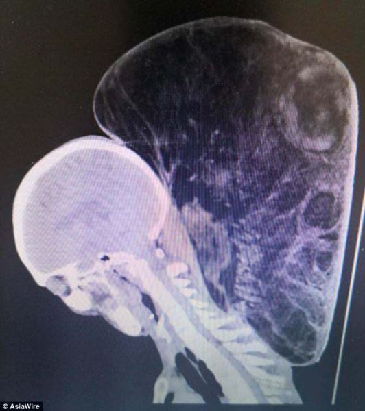 Китаец 47 лет "выращивал" на своей шее 15-килограммовую опухоль