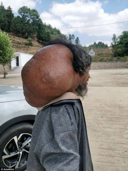 Китаец 47 лет "выращивал" на своей шее 15-килограммовую опухоль