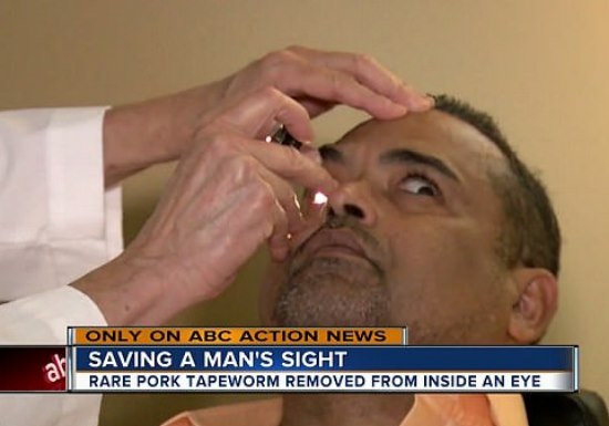 У жителя Флориды в глазу поселился свиной паразит